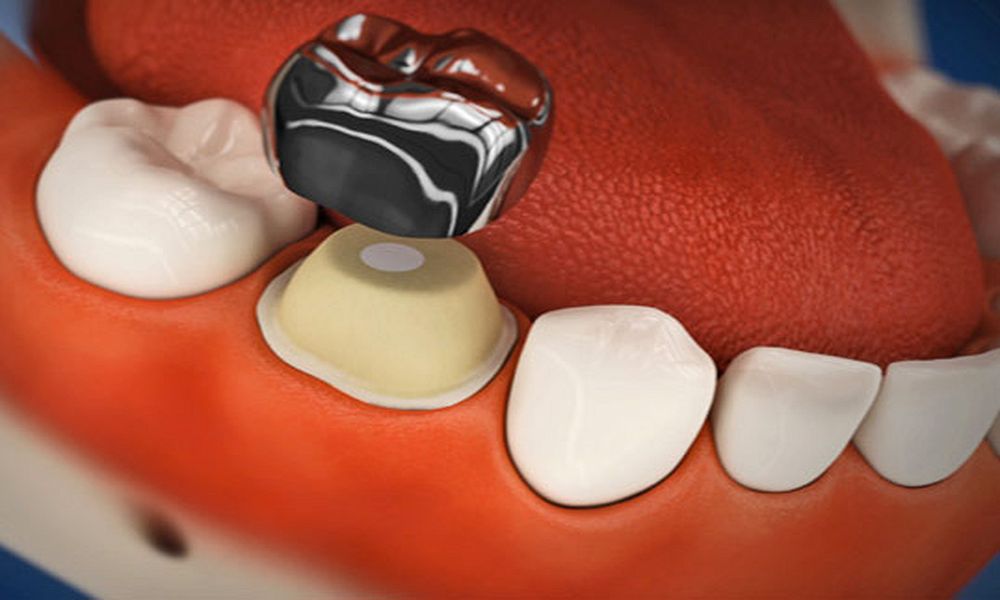 Pr&oacute;tesis y est&eacute;tica dental