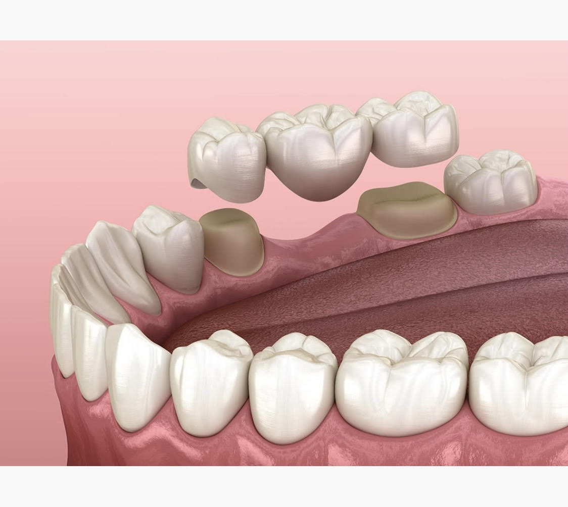 Pr&oacute;tesis y est&eacute;tica dental 1